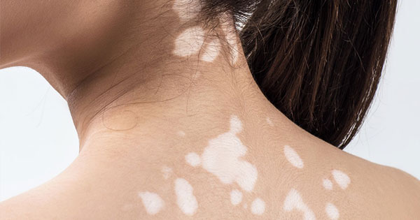 White spots on skin treatment in Vijayawada
